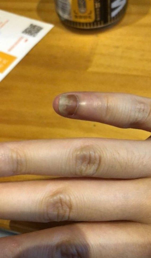 图片[1]-灰指甲怎么治？皮肤科内部方法总结：做好这2件事，告别灰指甲！-草根创业生活网